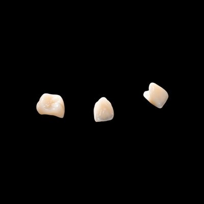 Porcelana CAD/CAM fusionada con puente de zirconio para restaurar su aspecto natural