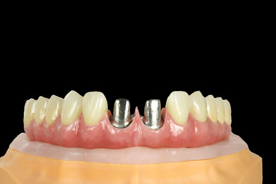comprar FDA Puente de titanio implante dental marco de titanio con corona online manufacture