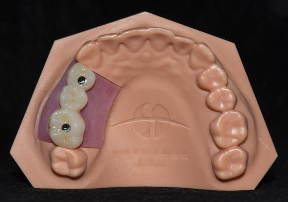 comprar Implante de porcelana fusionada con zirconia Implante de puente de corona muy estético online manufacture