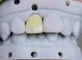 comprar Alta estética de la corona compuesta onlay veneer tamaño personalizable online manufacture