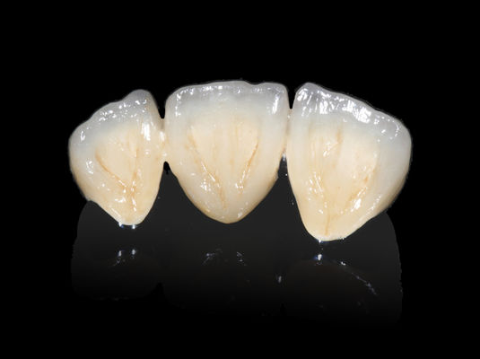 comprar Implante Dental PFM Puente No Precioso CAD CAM PFM Corona online manufacture
