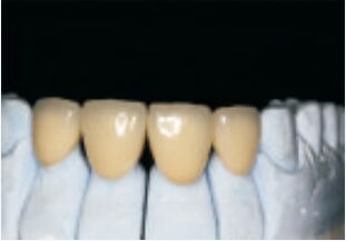 comprar Corona y puente de aleación preciosa blanca y preciosa online manufacture