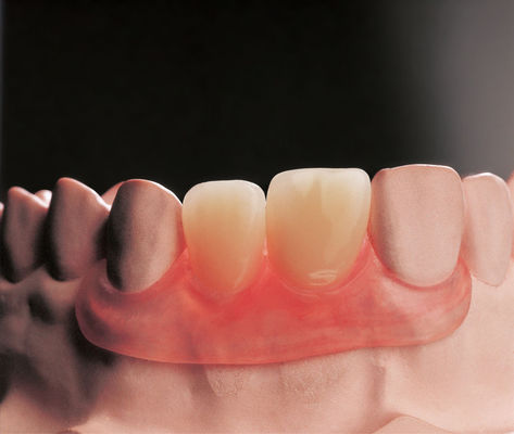 Dentaduras removibles con aletas flexibles Prostodoncia parcial clínica removible