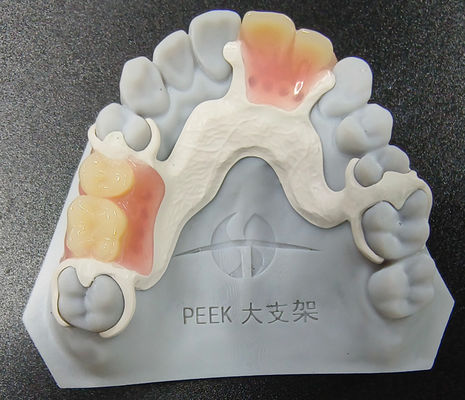 Personalizable Peek Dentura extraíble marco parcial resistencia al desgaste