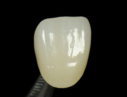 Coronilla de prensa de Emax personalizable rápida y alta estética de incrustación dental onlay