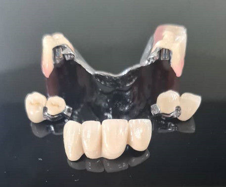 Cuadro metálico Apego de precisión Sobredentadura Dentadura extraíble