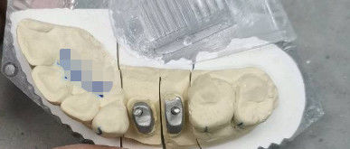 Coroa de base de Ti metálico / natural Coroa de Titanio para dientes