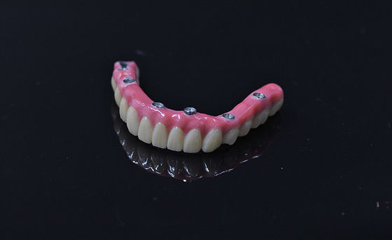 Implantación de dentaduras de carga inmediata Dientes artificiales extraíbles de color rosa claro