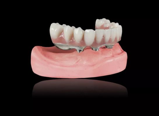 Implantes de barra de titanio Dentaduras removibles de aleación de titanio