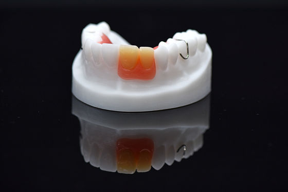Dentadura extraíble con aletas de acrílico Dentadura extraíble con acrílico personalizada