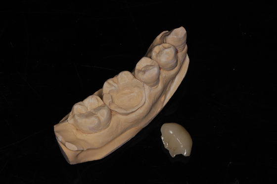 Dental Compuesto Onlay Veneer Alta estética Veneer compuesto